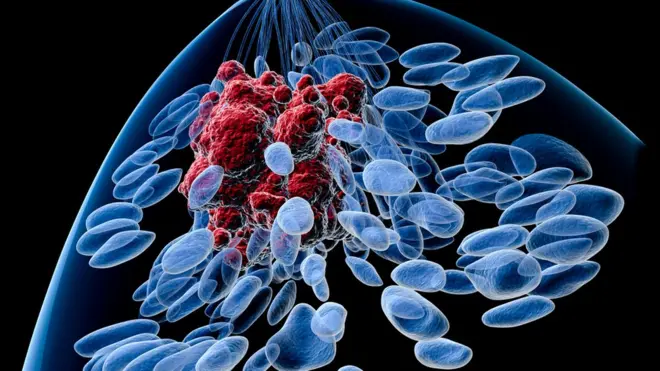 ڈاکٹر پیٹرز نے اس بات پر زور دیا کہ چھاتی کے سرطان کے علاج کے لیے سرجری میں کم آلات کا استعمال کریں