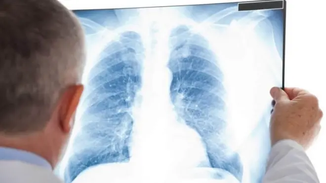 Пневмониядан каза болгондордун саны 350гө, коронавирус диагнозу коюлуп кайтыш болгондор 122ге жетти