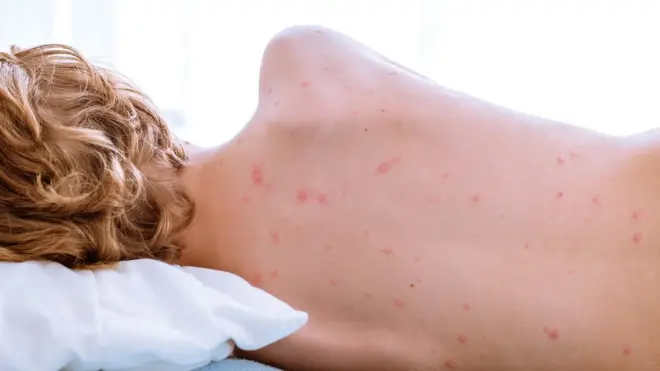 El último caso autóctono de sarampión se detectó en Venezuela en 2002.