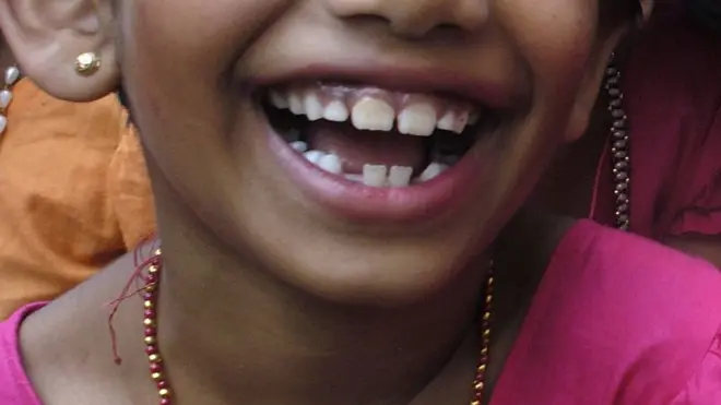 "කිරි දත් වැටෙන බැවින් ඒවා එතරම් වටිනා ඒවා නොවන බවට මවුවරු තුළ විශාල වැරදි විශ්වාසයක් තිබෙනවා"