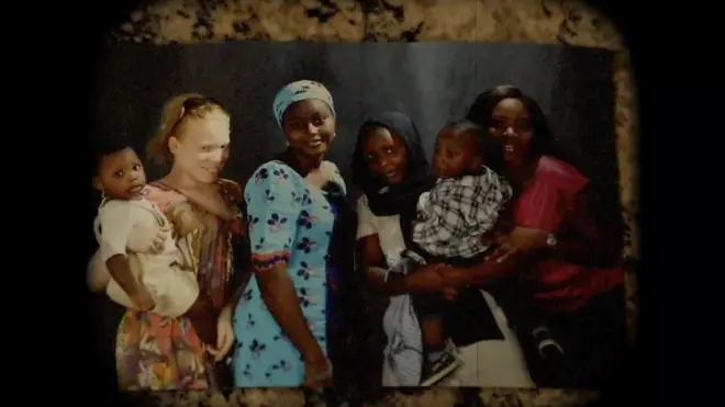 Kako klimatske promene utiču na ljude sa albinizmom