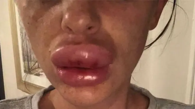 Madhara ya kuongeza ukubwa wa mdomo