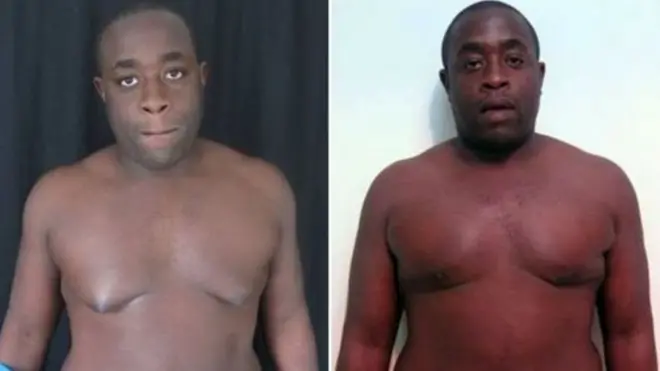 Ayo Adesina alikuwa na matati makubwa alipokuwa mtoto