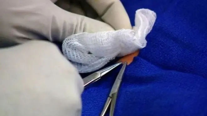 Les procédures illégales en matière de circoncision sont un sujet de préoccupation en Italie