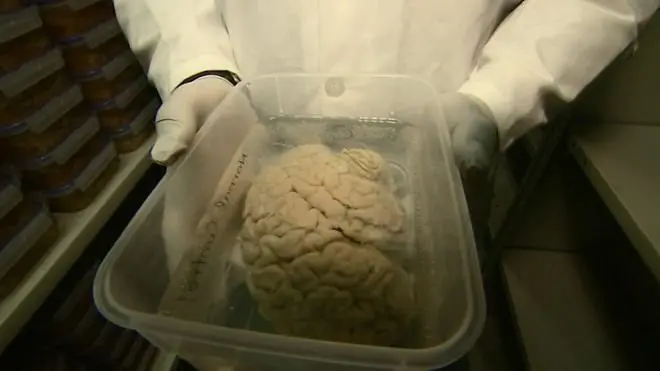 นักวิทยาศาสตร์เรียกร้องให้คนบริจาคสมองเพิ่มขึ้น