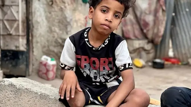 الطفل اليمني بدر الذي فقد جزءاً من ساقه في قصف للحوثيين على منزله