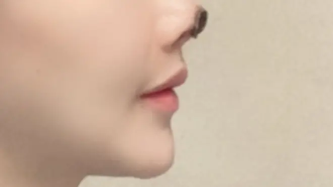 Di tissue for di end of Gao Liu's nose die afta di plastic surgery