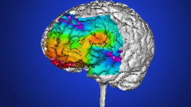 Drawing of brain wey get epilepsy.