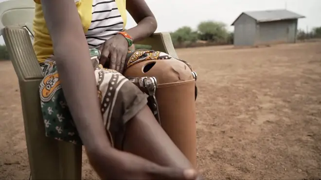 악어의 공격으로 다리를 잃고 의족을 착용한 여성