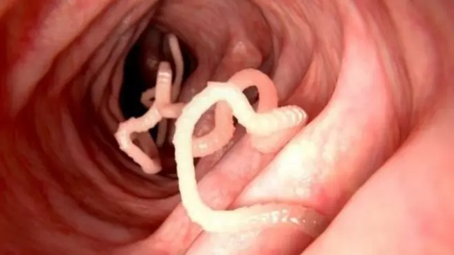 Parasit berupa cacing (foto generik) dapat hidup di usus manusia.
