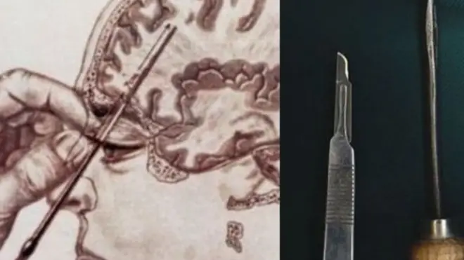 लोबोटॉमीः डोळ्याजवळ अणुकुचीदार शस्त्र घुसवून केलेली मेंदूची शस्त्रक्रिया का लोकप्रिय झाली होती?