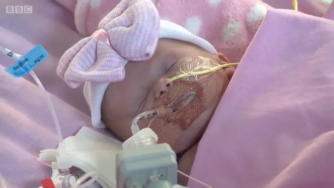 طفلة تولد بقلب خارج صدرها