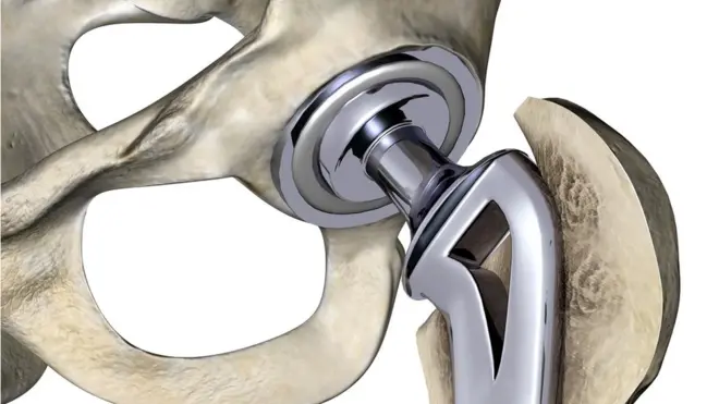 Как ожидается, из нового сплава получатся надежные тазобедренные имплантаты
