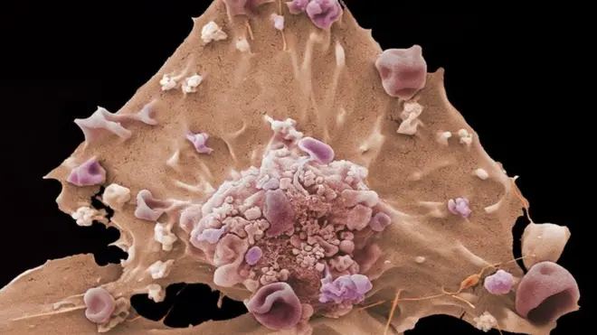 Breast cancer cell