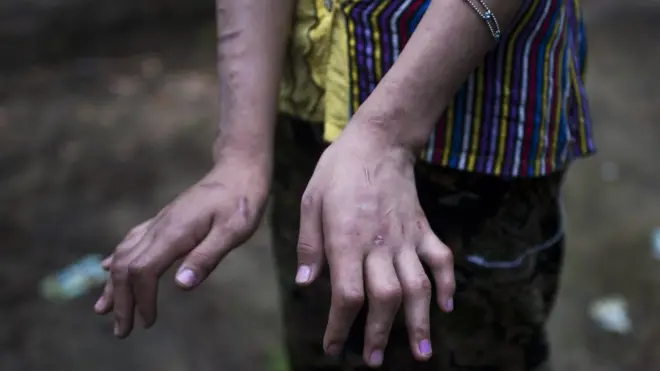 The girls' hands and arms are covered in scars