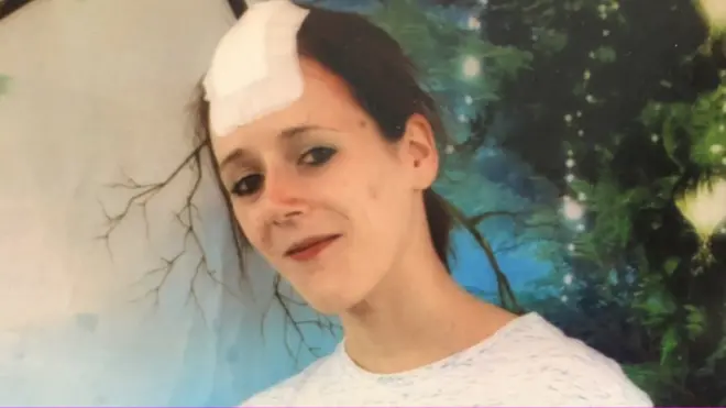 تقول والدة آيلا إن ابنتها أصيبت برقعة صلعاء في رأسها تسببت في عدم نمو الشعر فيها على الإطلاق، وربما تعاني من أضرار في المخ