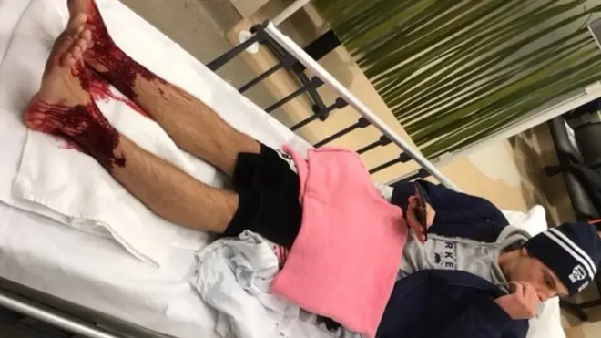 Sam Kanizay mengalami serangan berdarah saat berendam di pantai.