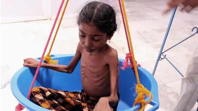 تنبيه: صورة أرشيفية لطفلة أخرى من محافظة الحجة اليمنية.