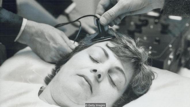 Médicos colocam eletrodos na cabeça de paciente durante simulação de sessão de ECT, em 1976