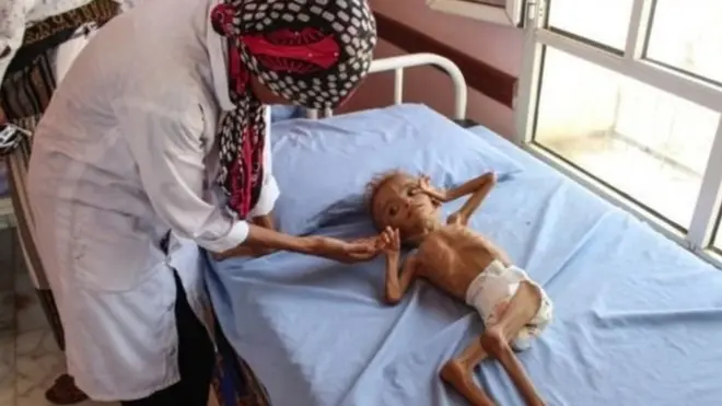 طفل يمني يعاني من سوء التغذية