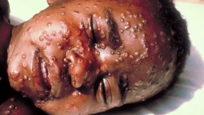 So far, di monkeypox never kill anybody since September when e start for Nigeria