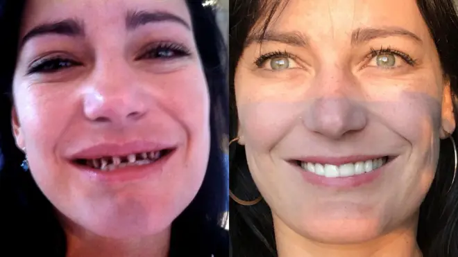 Natalia después de la operación y al final del tratamiento