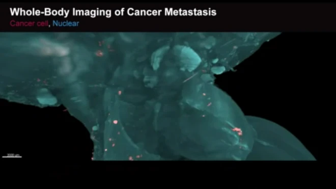 خلايا سرطانية