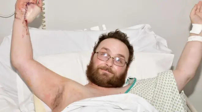 Povređena ruka sačuvana prišivanjem za stomak