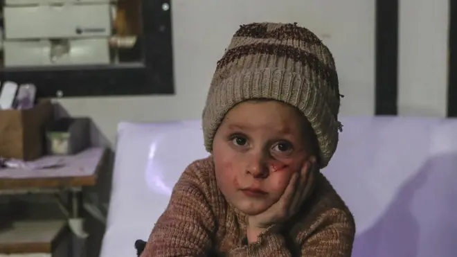 Yousef, 6, duduk di tempat tidur rumah sakit sambil menjalani perawatan akibat luka-lukanya karena pengeboman di Ghouta Timur.