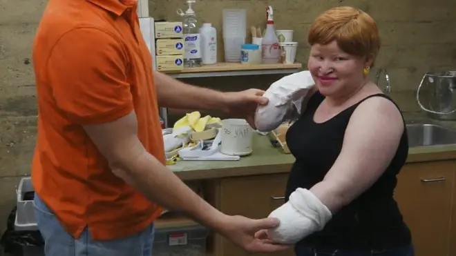 مريضة البرص " بتر جاري يديّ لكي يبعها"