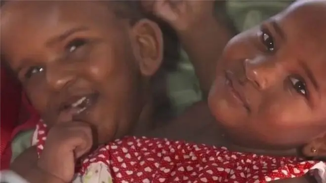 結合双生児のマリエムとンダイ