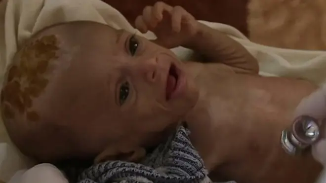 اقوام متحدہ کے مطابق یمن میں تقریباً چودہ ملین افراد کو خوراک کی قلت کا سامنا ہے۔