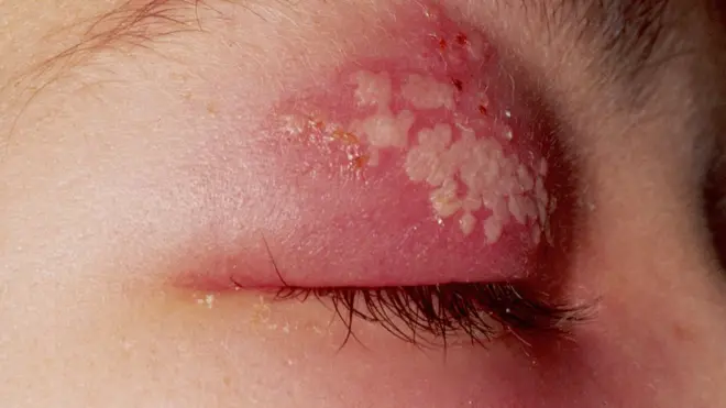 Uno de los primeros síntomas en bebés y niños son ampollas alrededor del ojo.