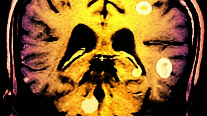 La tuberculosis cerebral es rara y puede ser mortal.