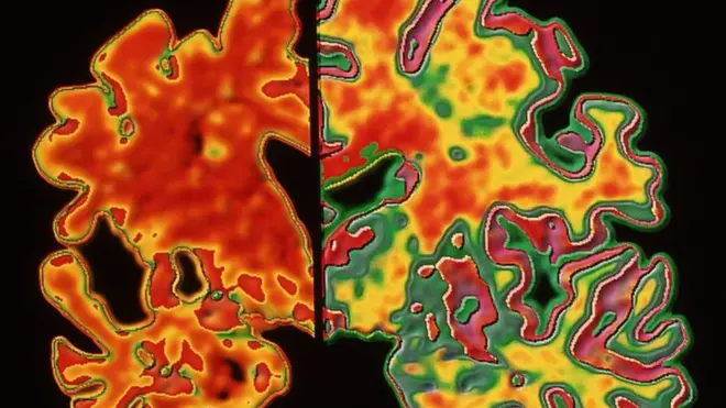 فراموشکاری