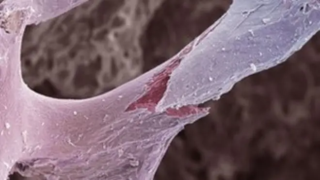 licha ya dawa hiyo kuonekana kutibu ugonjwa huo, huenda ikasababisha nyufa zaidi katika mifupa