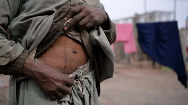 گردوں کی پیوند کاری