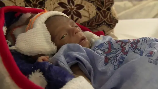 Yemen'de açlık çeken çocuklar