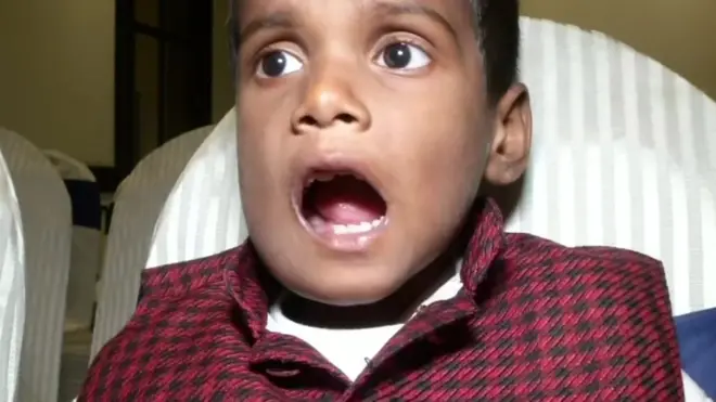 Ditemukan lebih dari 500 gigi di satu kantong di bagian bawah mulut anak laki ini.