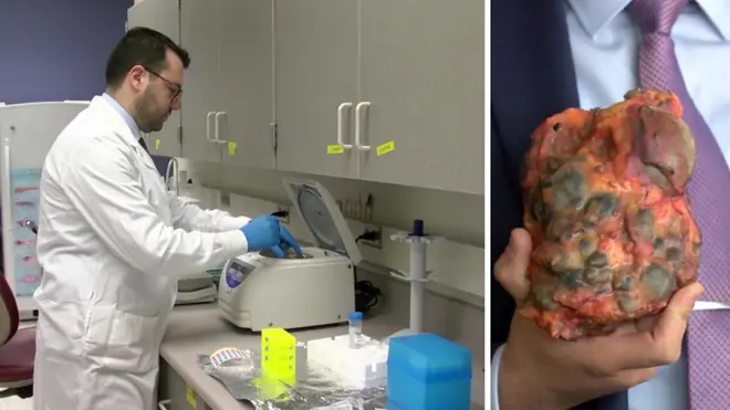 علاج جديد لمرض تكيس الكلى قد يكون بديلاً للغسيل والزراعة