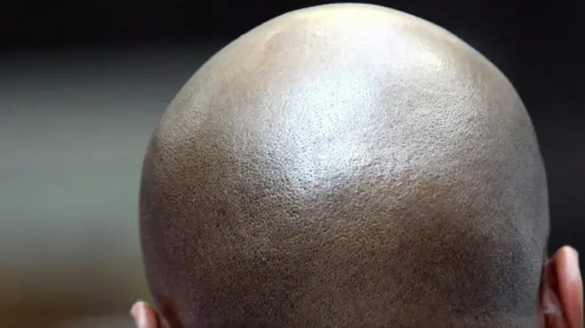 탈모는 언제,어떻게 진행되며 어떻게 대비할 수 있을까?