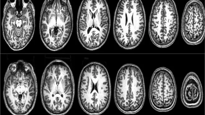 Imágenes de resonancia magnética del cerebro