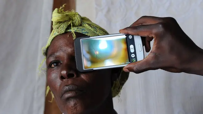 Sub-sahara Africa get di biggiest number of people wey blind from glaucoma.