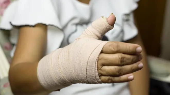 Щойно ви зрозуміли, що зламали руку, негайно зверніться до лікаря