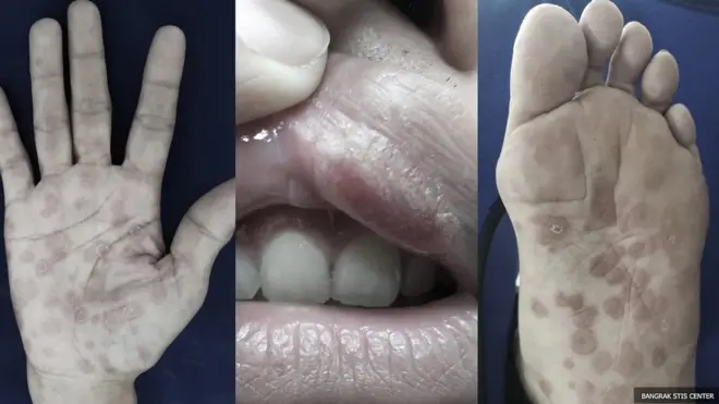 วิธีการสังเกตตัวเองง่าย ๆ คือการดูแผลและผื่นที่ขึ้นตามส่วนต่าง ๆ ของร่างกาย