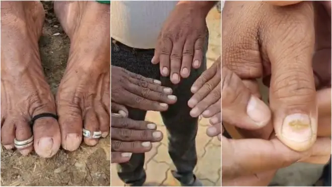 केसगळतीनंतर आता बुलढाण्यात नखगळतीची प्रकरणे समोर येऊ लागली आहेत.