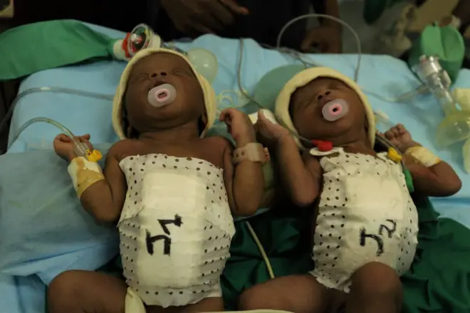 Les deux siamoises après l'opération