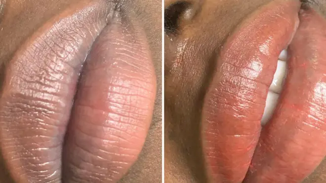 Des lèvres avant l'opération (à gauche) et des lèvres après l'opération (à droite)