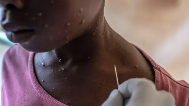 Ọmọkunrin yii n gba itọju fun arun mpox niluu Munigi, lorilẹede DR Congo.