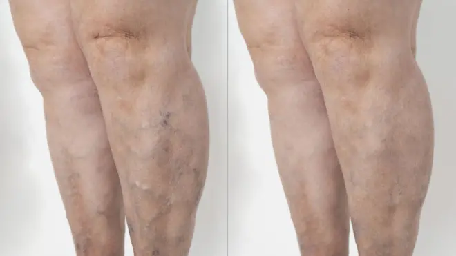 ਵੈਰੀਕੋਜ਼ ਵੇਨਜ਼